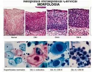 Cáncer cervicouterino. Patología Especial.