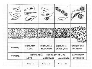Cáncer cervicouterino. Patología Especial.