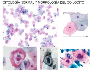 Cáncer cervicouterino. Patología Especial.