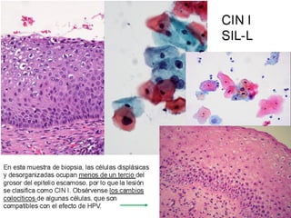Cáncer cervicouterino. Patología Especial.