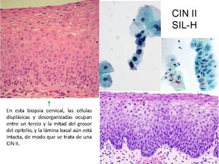 Cáncer cervicouterino. Patología Especial.