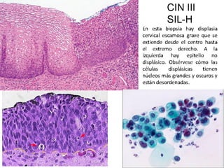 Cáncer cervicouterino. Patología Especial.