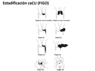 Cáncer cervicouterino. Patología Especial.