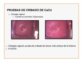 Cáncer cervicouterino. Patología Especial.