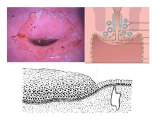 Cáncer cervicouterino. Patología Especial.