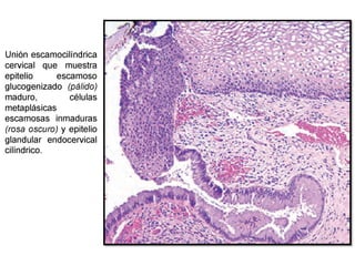 Cáncer cervicouterino. Patología Especial.