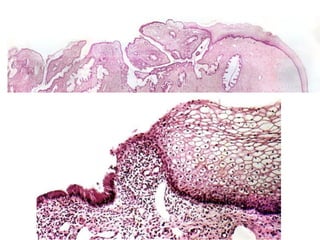 Cáncer cervicouterino. Patología Especial.
