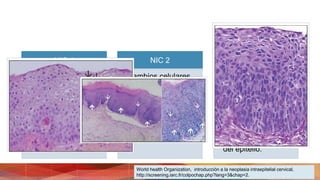 NIC 1
• Buena maduración
• mínimas anomalías
nucleares y pocas
figuras mitóticas
• Las células
indiferenciadas en
capas profundas
NIC 2
• Cambios celulares
displásicos sobre
todo a la mitad o los
dos tercios
inferiores del
epitelio.
NIC 3
• Diferenciación y la
estratificación
pueden faltar por
completo, con
abundantes figuras
mitóticas
• Las anomalías
nucleares aparecen
en todo el espesor
del epitelio.
World health Organization, introducción a la neoplasia intraepitelial cervical,
http://screening.iarc.fr/colpochap.php?lang=3&chap=2.
 