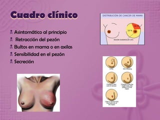 Cuadro clínico
 Asintomático al principio
 Retracción del pezón
 Bultos en mama o en axilas
 Sensibilidad en el pezón
 Secreción
 