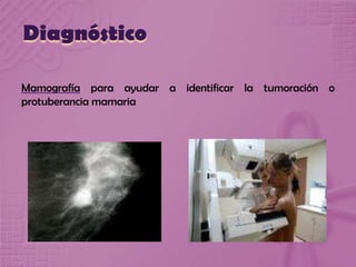 Diagnóstico
Mamografía para ayudar a identificar la tumoración o
protuberancia mamaria
 