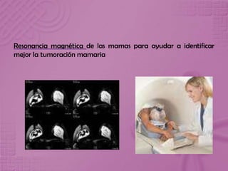 Resonancia magnética de las mamas para ayudar a identificar
mejor la tumoración mamaria
 