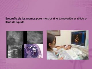 Ecografía de las mamas para mostrar si la tumoración es sólida o
llena de líquido
 