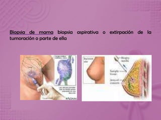 Biopsia de mama biopsia aspirativa o extirpación de la
tumoración o parte de ella
 
