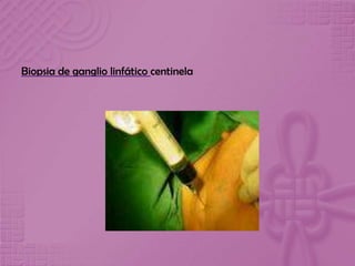 Biopsia de ganglio linfático centinela
 