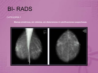 BI- RADS
CATEGORÍA 1
Mamas simétricas, sin nódulos, sin distorsiones ni calcificaciones sospechosas.
 