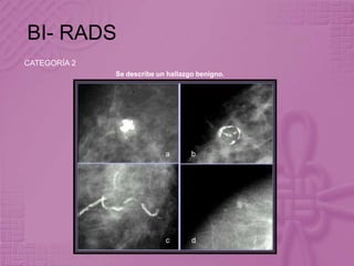 BI- RADS
CATEGORÍA 2
Se describe un hallazgo benigno.
 