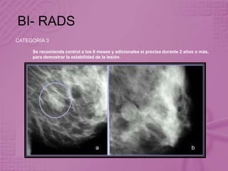 BI- RADS
CATEGORÍA 3
Se recomienda control a los 6 meses y adicionales si precisa durante 2 años o más,
para demostrar la estabilidad de la lesión.
 
