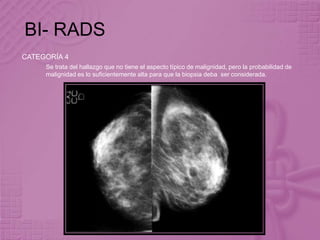 BI- RADS
CATEGORÍA 4
Se trata del hallazgo que no tiene el aspecto típico de malignidad, pero la probabilidad de
malignidad es lo suficientemente alta para que la biopsia deba ser considerada.
 