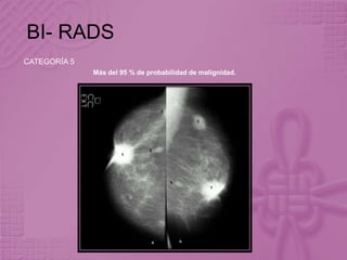 BI- RADS
CATEGORÍA 5
Más del 95 % de probabilidad de malignidad.
 