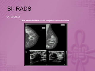 BI- RADS
CATEGORÍA 6
Debe de realizarse la acción terapéutica más adecuada.
 