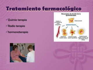 Tratamiento farmacológico
Quimio terapia
Radio terapia
hormonoterapia
 