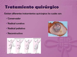 Tratamiento quirúrgico
Existen diferentes tratamientos quirúrgicos los cuales son:
Conservador
Radical curativo
Radical paliativo
Reconstructivo
 