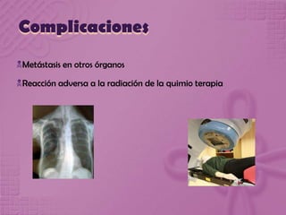 Complicaciones
Metástasis en otros órganos
Reacción adversa a la radiación de la quimio terapia
 