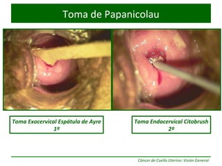 Toma de Papanicolau Toma Exocervical Espátula de Ayre 1º Toma Endocervical Citobrush 2º 