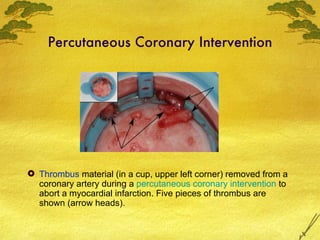 Percutaneous Coronary Intervention <ul><li>Thrombus  material (in a cup, upper left corner) removed from a coronary artery...