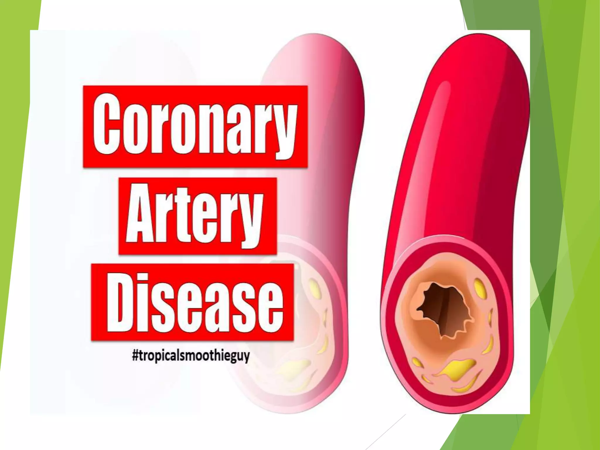 coronary artery disease | PPTX