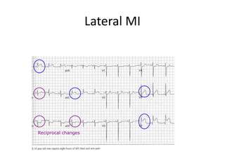 Lateral MI
Reciprocal changes
 