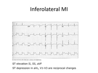 Inferolateral MI
ST elevation II, III, aVF
ST depression in aVL, V1-V3 are reciprocal changes
 