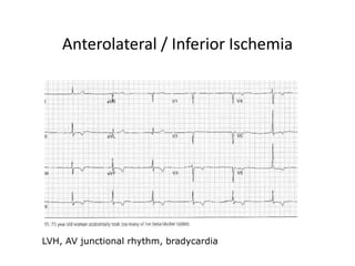 Anterolateral / Inferior Ischemia
LVH, AV junctional rhythm, bradycardia
 
