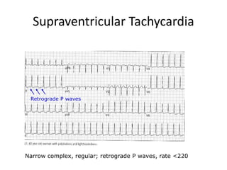 Supraventricular Tachycardia
Narrow complex, regular; retrograde P waves, rate <220
Retrograde P waves
 