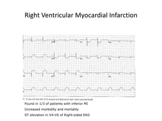Right Ventricular Myocardial Infarction
Found in 1/3 of patients with inferior MI
Increased morbidity and mortality
ST elevation in V4-V6 of Right-sided EKG
 