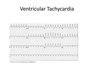Ventricular Tachycardia
 