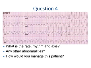 Question 4
 What is the rate, rhythm and axis?
 Any other abnormalities?
 How would you manage this patient?
 