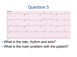 Question 5
 What is the rate, rhythm and axis?
 What is the main problem with the patient?
 