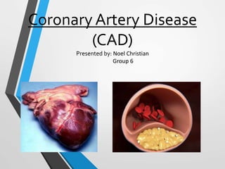 Coronary Artery Disease
(CAD)
Presented by: Noel Christian
Group 6
 