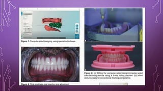 Cad cam in prosthodontics | PPTX