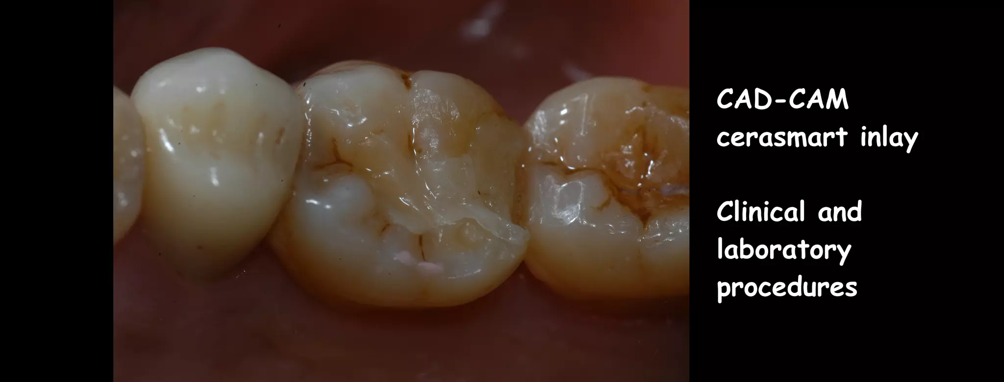 CAD-CAM inlay made by Aadva lab scanner and Cerasmart Block | PPT