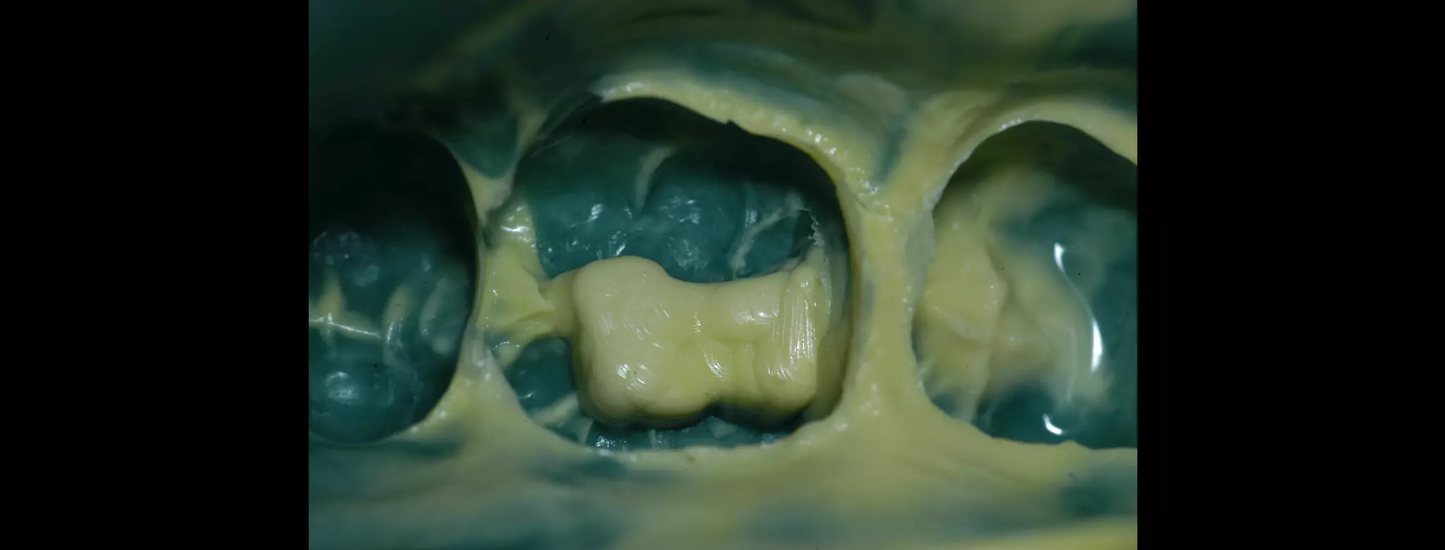 CAD-CAM inlay made by Aadva lab scanner and Cerasmart Block | PPT