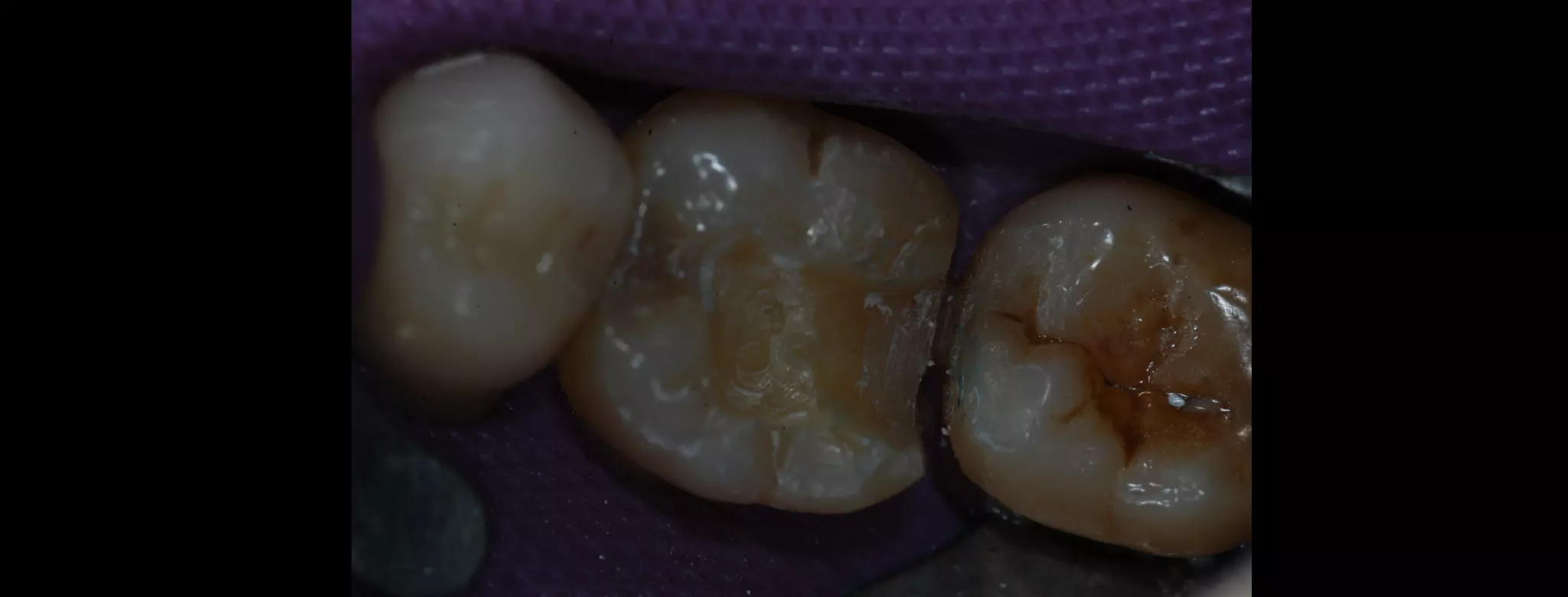 CAD-CAM inlay made by Aadva lab scanner and Cerasmart Block | PPT