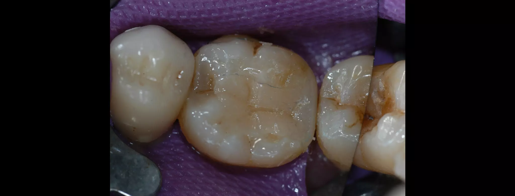 CAD-CAM inlay made by Aadva lab scanner and Cerasmart Block | PPT