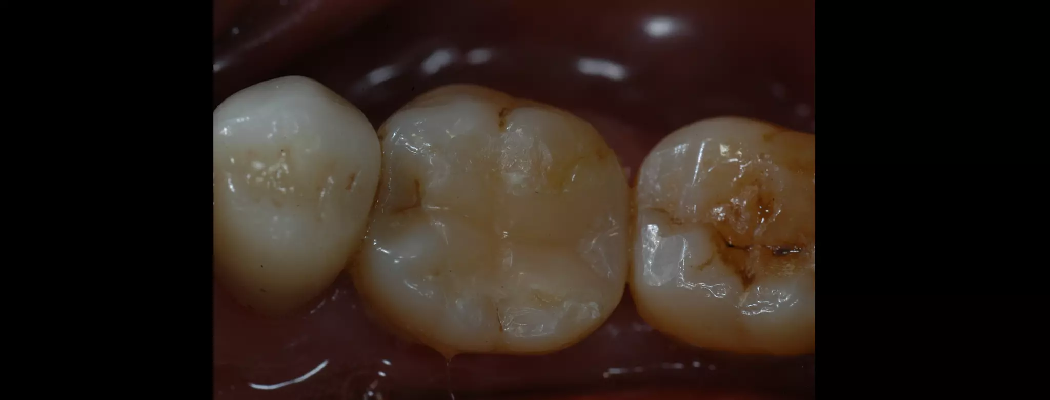 CAD-CAM inlay made by Aadva lab scanner and Cerasmart Block | PPT