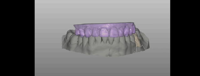 CAD-CAM inlay made by Aadva lab scanner and Cerasmart Block | PPT