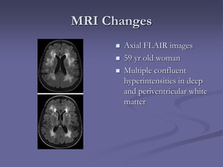 MRI Changes
 Axial FLAIR images
 59 yr old woman
 Multiple confluent
hyperintensities in deep
and periventricular white
matter
 