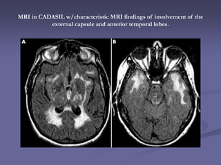 MRI in CADASIL w/characteristic MRI findings of involvement of the
external capsule and anterior temporal lobes.
 