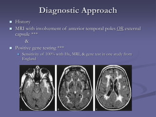 Diagnostic Approach
 History
 MRI with involvement of anterior temporal poles OR external
capsule ***
&
 Positive gene testing ***
 Sensitivity of 100% with Hx, MRI, & gene test in one study from
England
 
