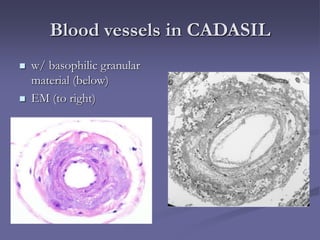 Blood vessels in CADASIL
 w/ basophilic granular
material (below)
 EM (to right)
 